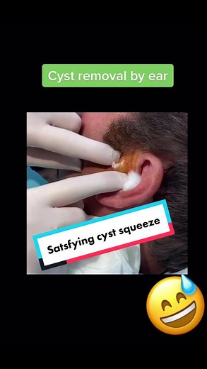 Cyst extraction by ear. #extractions #extractionslovers #cystpopping #cystexplosion #blackheadsremoval #whiteheadextraction #pimplepopper