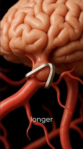 Inside Aneurysm Clipping – Life-Saving Brain Surgery