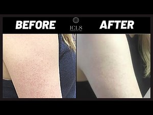 Treating Keratosis Pilaris *Chicken Skin* | Dermatologist Tips | ICLS Dermatology & Plastic Surgery