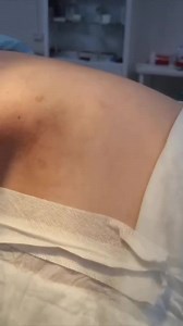 Surgeon Pull Out Large Caliber Bullet through Incision