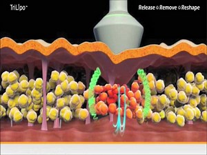 Are you feeling ready for the Beach? Is your Body ready though? Want to get into that SPECIAL dress?? The very latest treatment is HERE!! The LipoFirm Pro with GUARANTEED results! Amazing technology! Lose inches, sculpt your body! Get rid of stubborn fatty areas! Suitable for both MEN and WOMEN!! Watch this video to see how this baby gets to work!! :-) Book your course NOW!! | Thalia Beauty Studio | Facebook