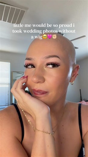 BALD BRIDE HEREEE #alopecia #wigs #hairtok #hairloss