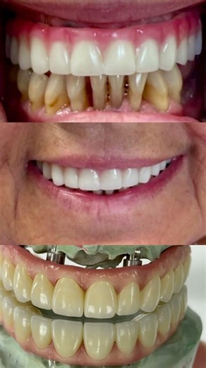 Very sophisticated full mouth implants zirconia from Temporary!