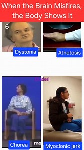Abnormal Movements — Can You Tell Them Apart? In this clip you’re seeing 4 classic movement disorders running together: Athetosis • Chorea • Myoclonus • Dystonia Here’s how to recognize them in 10 seconds 👇 🌀 Athetosis → slow, writhing, snake-like hands 💃 Chorea → fast, irregular, dance-like movements ⚡ Myoclonic jerk → sudden, brief shock-like jerks 🪢 Dystonia → sustained twisting & abnormal posture 🌙 Sleep Clue (High-yield) • Disappears in sleep? → Basal ganglia • Persists in sleep? → Cor