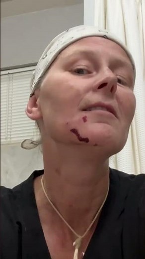 Neighbors Dog Bit Me In The Face