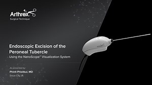 Endoscopic Excision of the Peroneal Tubercle Using the NanoScope™ Visualization System