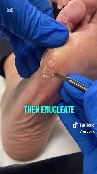 Painful hard corn removal by podiatrist. Very very painful. #corn #callua #podiatrist #ergonx ergonx.com.au #satisfying