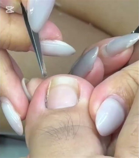 clear thick yellow toenails, foot health tips, podiatrist toenail fungus