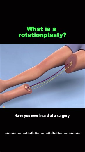 What is a rotationplasty?#science #knowledge #fouryou #tktok | science