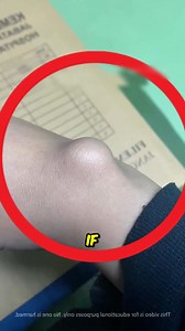 1.6M views · 7.8K reactions | Trick To Remove The Bump On Your Hand  . . . . . . . #Remove #yourhand #explorepage #exploremore #reelsviralシfb #reels | Labeeway | Facebook