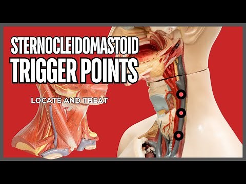 Understanding Trigger Points in the Sternocleidomastoid Muscle