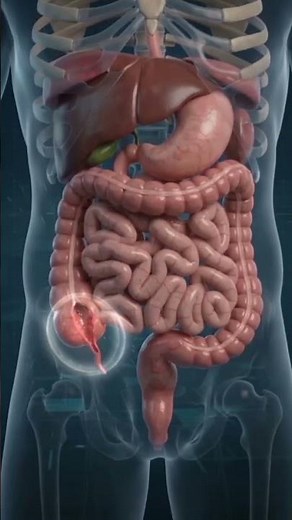 Your Appendix Could BURST and You Wouldn't Know It😥|#appendicitis|#appendix location and symptoms