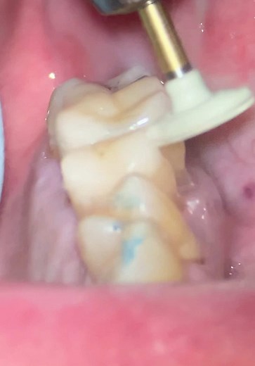Deep Margin Elevation in Endodontics: Techniques and Tips