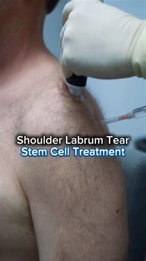 Labrum Tear Stem Cell Injection | Ultrasound Guided Shoulder Treatment