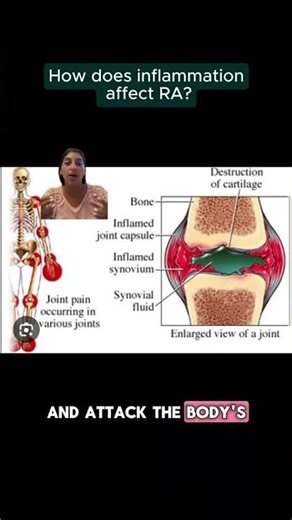 What Is Inflammation—And How Does It Affect Rheumatoid Arthritis?