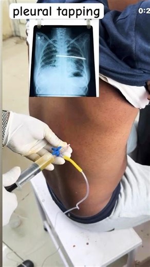 ✅ pleural tapping procedure #shortsfeed #pleuraleffusion #pleural #medicalprocedure #facts #nursing