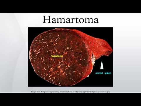 Hamartoma