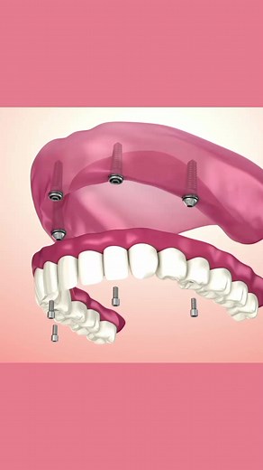 6K views · 81 reactions | Implant Supported Denture | 3D Animation | Dental Daily | Facebook
