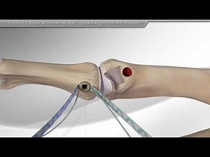 Thumb UCL Repair With InternalBrace™ Ligament Augmentation Procedure
