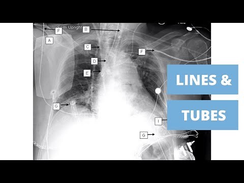 Beginners Guide to Lines and Tubes - How to Read a Chest Xray