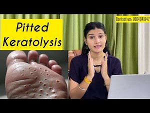 Pits on foot?? Its Pitted keratolysis | causes | symptoms | solution | Treatment| #shubhhomoeopathy
