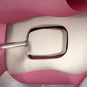 Piezomed – Animation of a lateral sinus lift at position Q2/no 6 using Piezomed. Instruments used: S1, S2, S3, S4, S5 👉https://www.wh.com/en_global/dental-products/oralsurgery-implantology/accessories/piezomed-instruments/ | W&H Dentalwerk