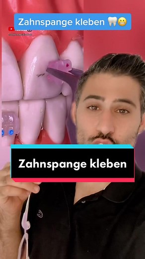 How to Attach Braces Correctly