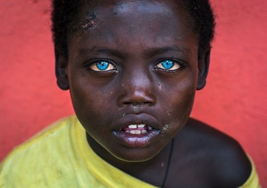 Waardenburg Syndrome: Meet 5 People With The Rare Genetic Mutation