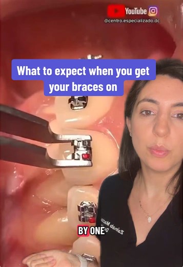 Getting Braces: What to Expect During Your Appointment