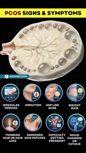 🟣 8 Warning Signs of PCOS (Polycystic Ovary Syndrome): ➟ PCOS is a common hormonal condition linked with irregular ovulation, higher androgen (male-hormone) effects, and often insulin resistance. Symptoms vary—some women have mainly period issues, others have acne/hair or weight-related symptoms. 🟣 1) Irregular periods ➟ Cycles >35 days, missed periods, or unpredictable bleeding → Long gaps can cause heavy bleeding when periods finally come 🟣 2) Excess facial/body hair (hirsutism) ➟ Thick coa