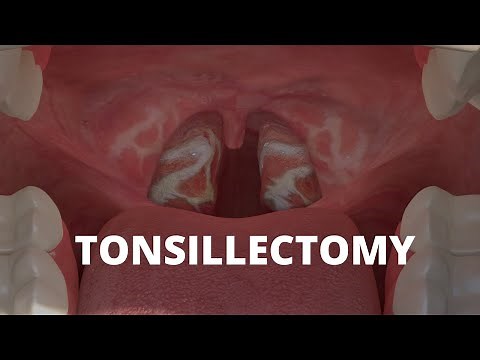 What is Tonsillectomy?