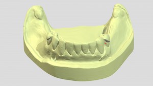 Class I Kennedy RPD Cast - 3D model by ramiammoun