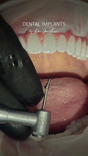 Xcell Dental Implants: Before & After Transformation