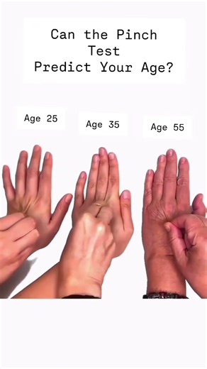 Try The Skin Pinch Test With Me!