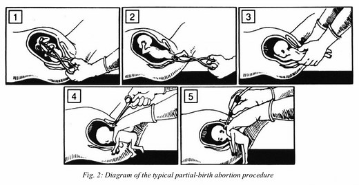 Special Report: Partial-Birth Abortion at Planned Parenthood
