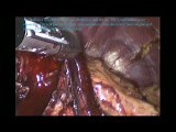 Laparoscopic D2 Radical Total Gastrectomy for Gastric Cancer • Video • MEDtube.net