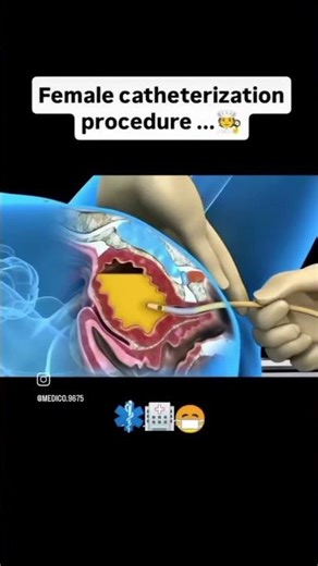 female catheterization procedure #catheterization #procedures #animation #nursing #norcet #rrb