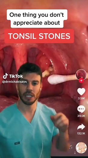 Understanding Tonsil Stones: Causes and Removal Tips
