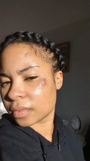 A cyst randomly appeared on my face and it took a year to fully heal #skincare