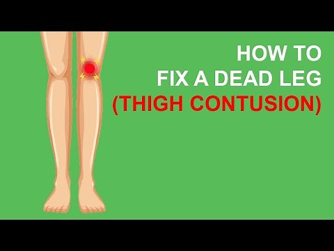 How to fix a dead leg (Thigh contusion)