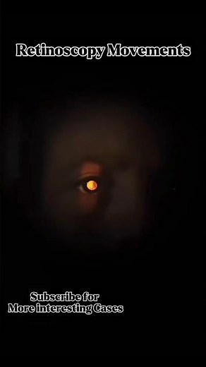 Retinoscopic Reflex/Movements Demo|With movements #myopia #retinoscopicreflex #refraction