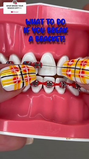 How to Fix a Broken Braces Bracket: Tips and Tricks