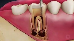 199K views · 3.2K reactions | #အေၾကာထုတ္ကုသျခင္း(Root Canal therapy)...