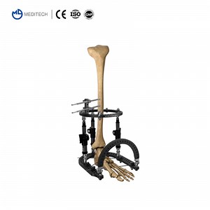 [Hot Item] Orthopaedic Instruments Ilizarov Ring External Fixator for Tibial & Femur Fracture