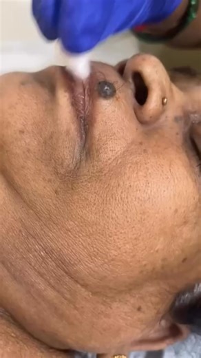 Dr Sarika More Nannaware | Upper lip mole removal with radio frequency cauterisations under local anaesthesia is a simple painless procedure can be performed without... | Instagram