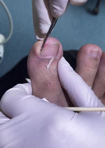 Effective Ingrown Toenail Treatments for Quick Relief