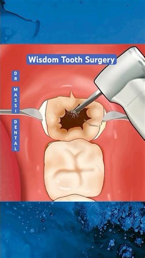 Wisdom Tooth Surgical Removal