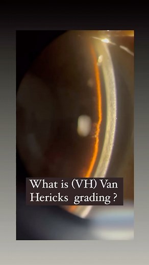 Dr.Dhruval Khurana on Instagram: "The Van Herick technique is an eye examination method used to determine the size of the anterior chamber angle of the eye.The Van Herick’s technique has become the most commonly used qualitative method of assessing the size of the anterior chamber angle (ACA). Whereby, it involves comparing the depth of the peripheral anterior chamber to the thickness of the cornea, when a narrow beam is shone within the limbus at a 60°angle.The Van Herick’s technique compares t