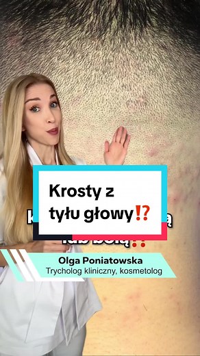 Krosty z tyłu głowy: Przyczyny i rozwiązania