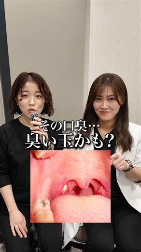 その口臭…臭い玉が原因？ #歯医者 #矯正歯科 #歯科医師